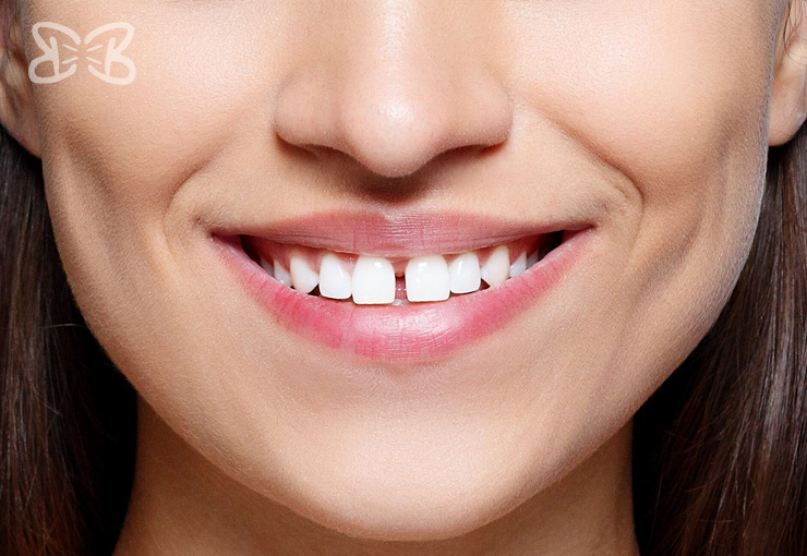 Cierre de Espacios entre Dientes en Puebla
