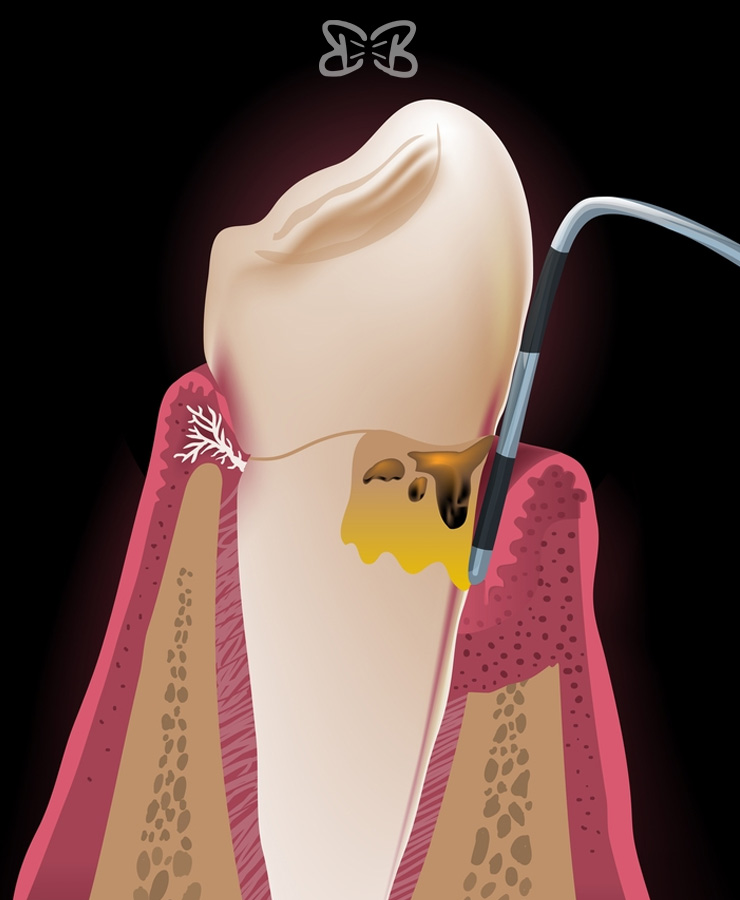 Periodoncia en Puebla