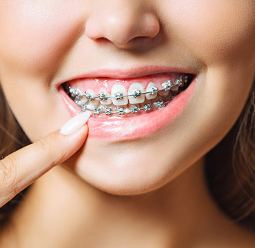 Brackets Convencionales