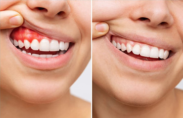 Check Up Dental en Puebla