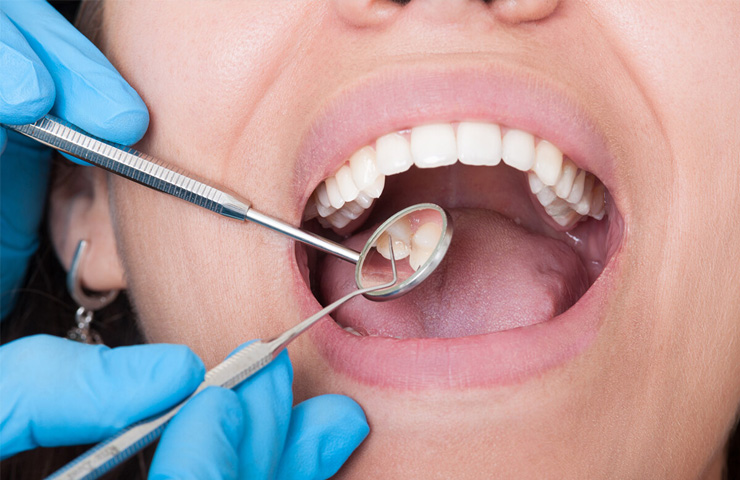 Servicios de Prevención Dental en Puebla