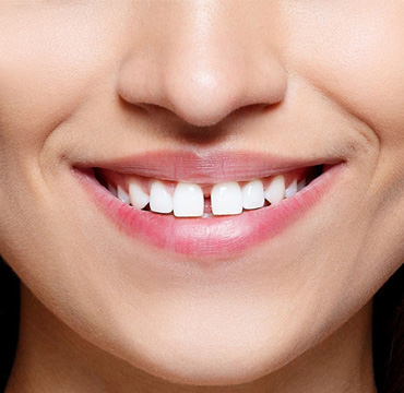 Alineadores Invisibles