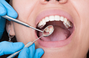 Cierre de Espacios entre Dientes sin Prótesis en Puebla