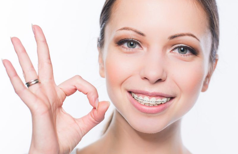 Aplicación de Brackets Estéticos Autoligado Baja Fricción en Puebla