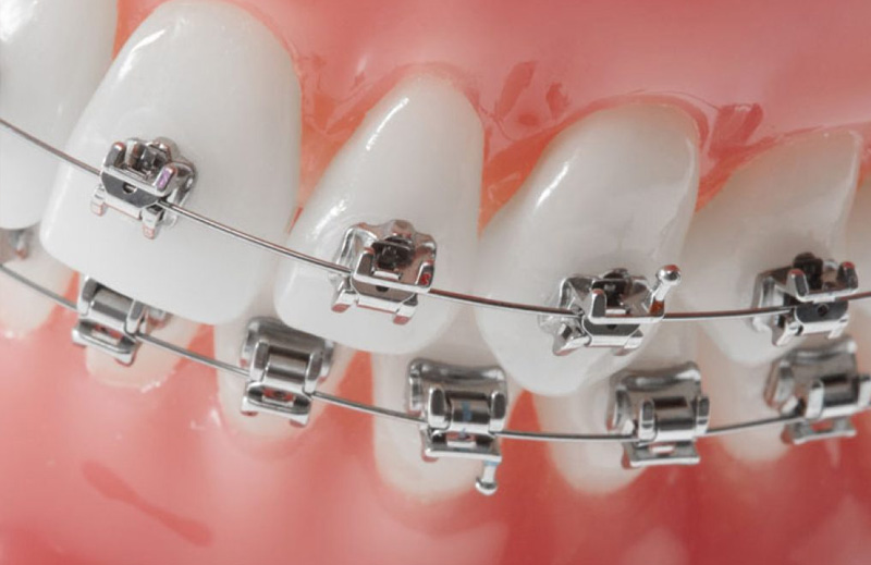 Aplicación de Brackets Estéticos Autoligado Baja Fricción en Puebla