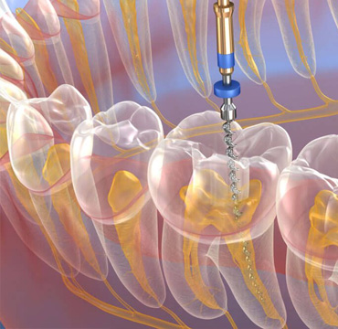 Endodoncia en Puebla