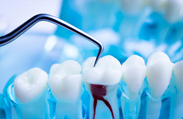 Tratamientos de Endodoncia en Puebla