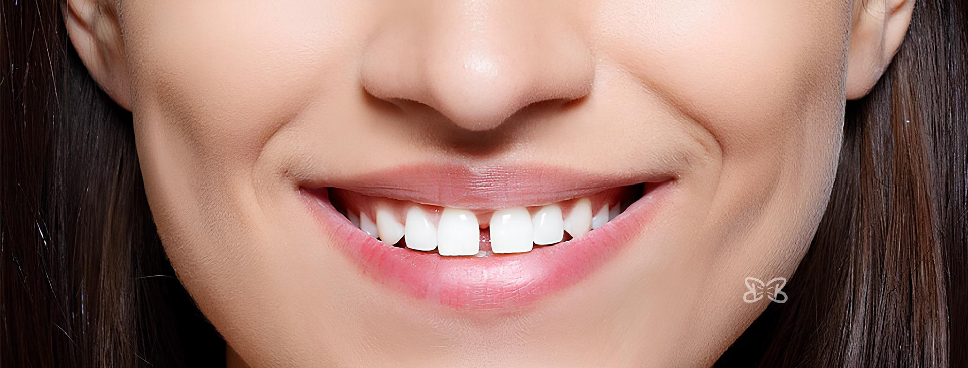 Cierre de Espacios entre Dientes sin Prótesis en Puebla