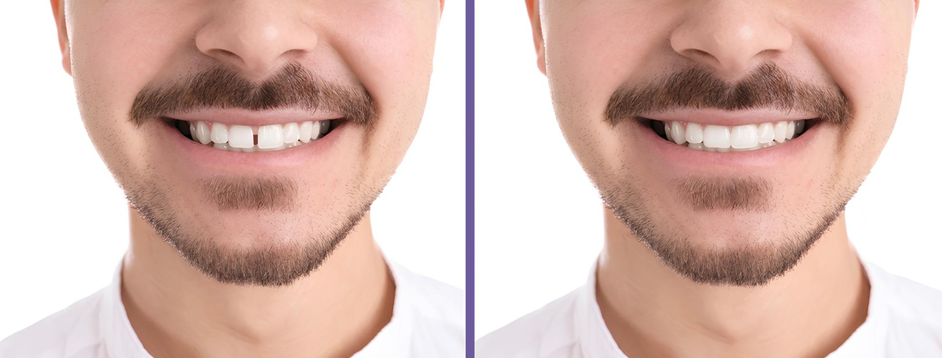 Cierre de Espacios entre Dientes sin Prótesis en Puebla