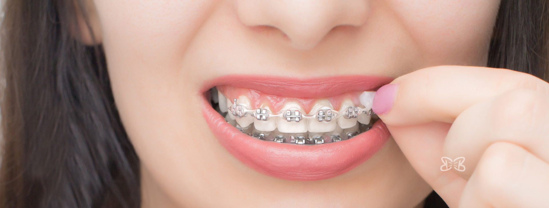 Aplicación de Brackets Estéticos Autoligado Baja Fricción en Puebla